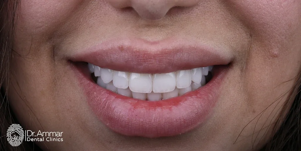 ابتسامة هوليوود — بعد