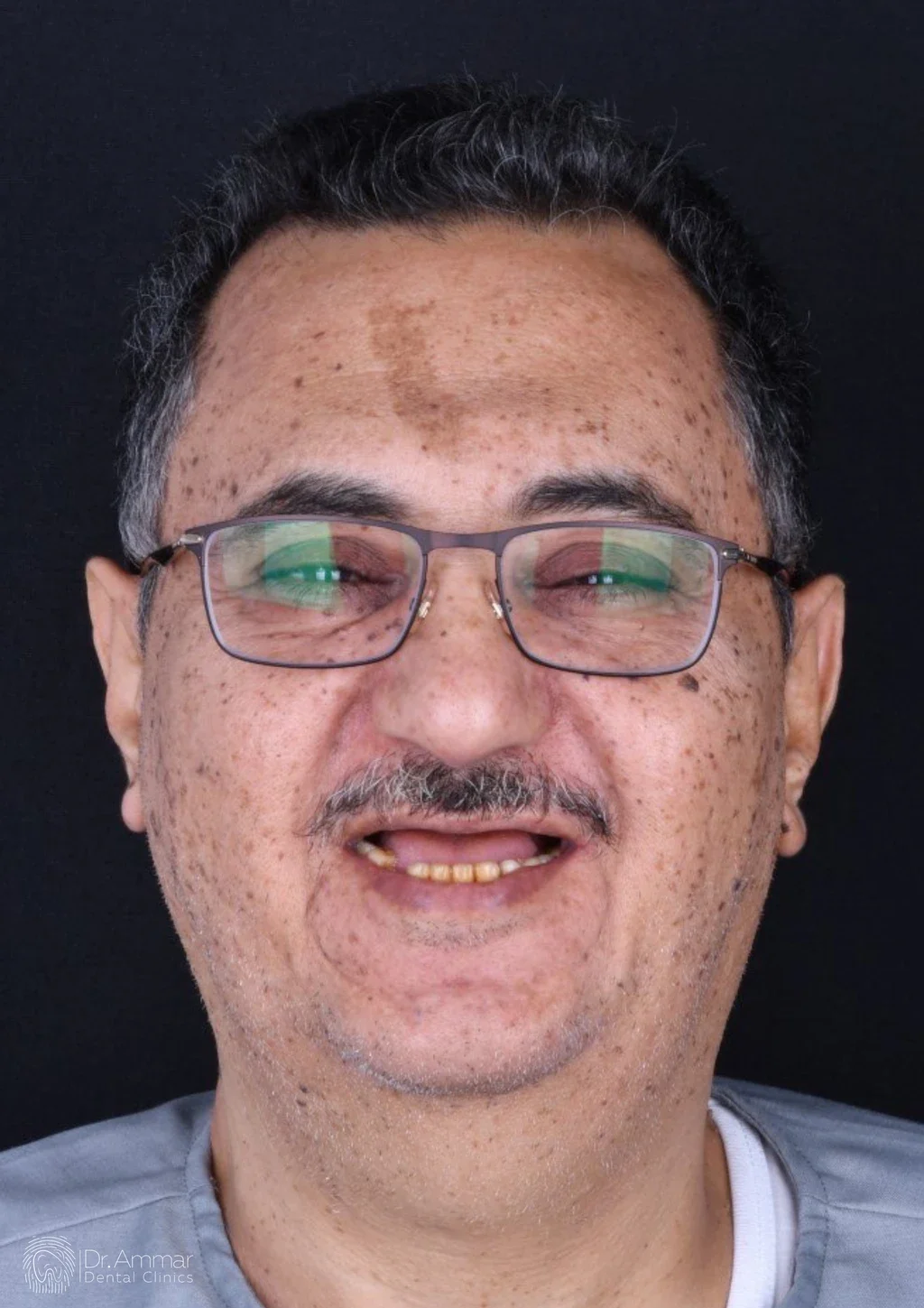 زراعة الفك بالكامل — قبل