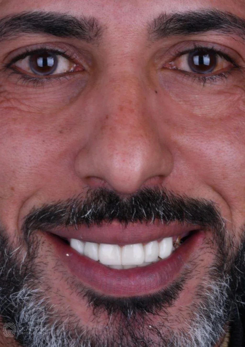 إعادة تأهيل الفكين — بعد
