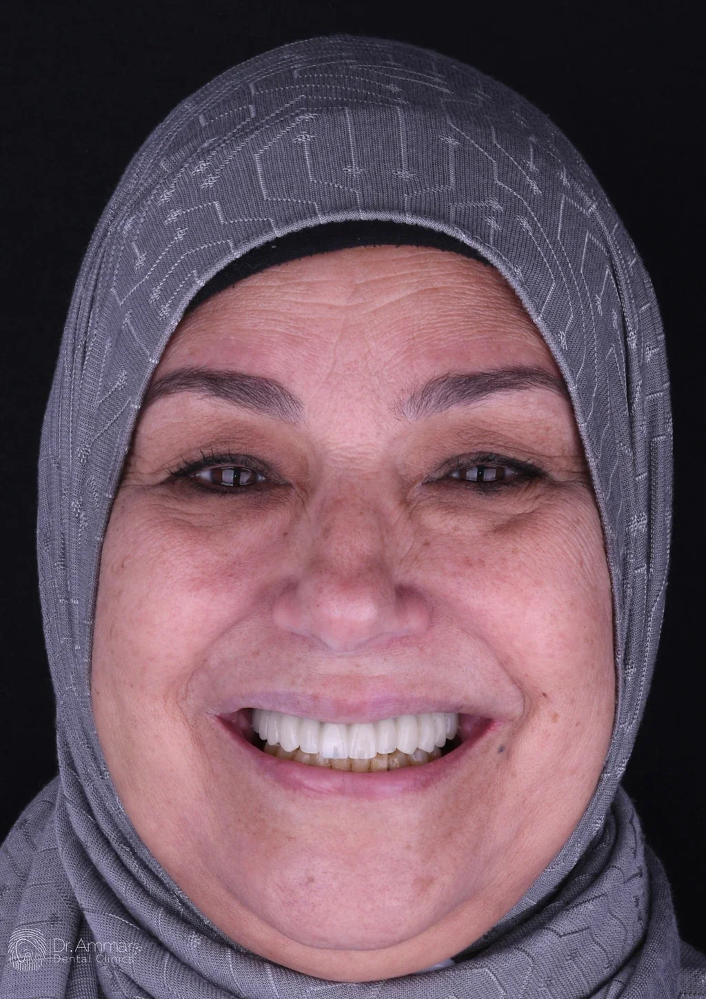 زراعة الفك بالكامل — بعد