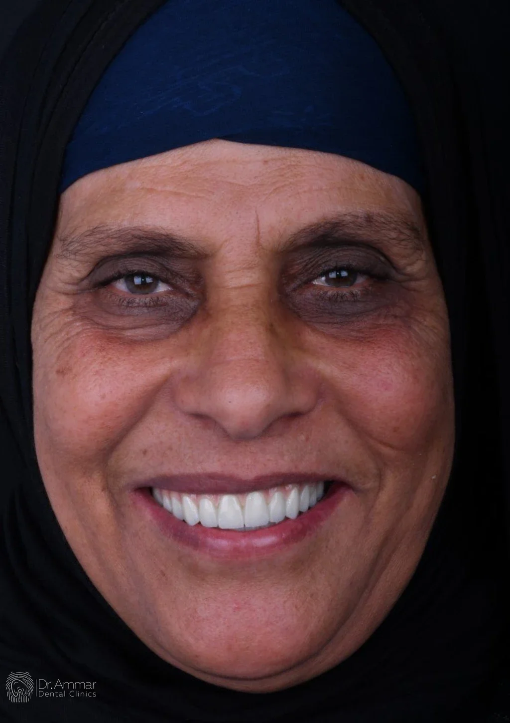 زراعة الفك بالكامل — بعد