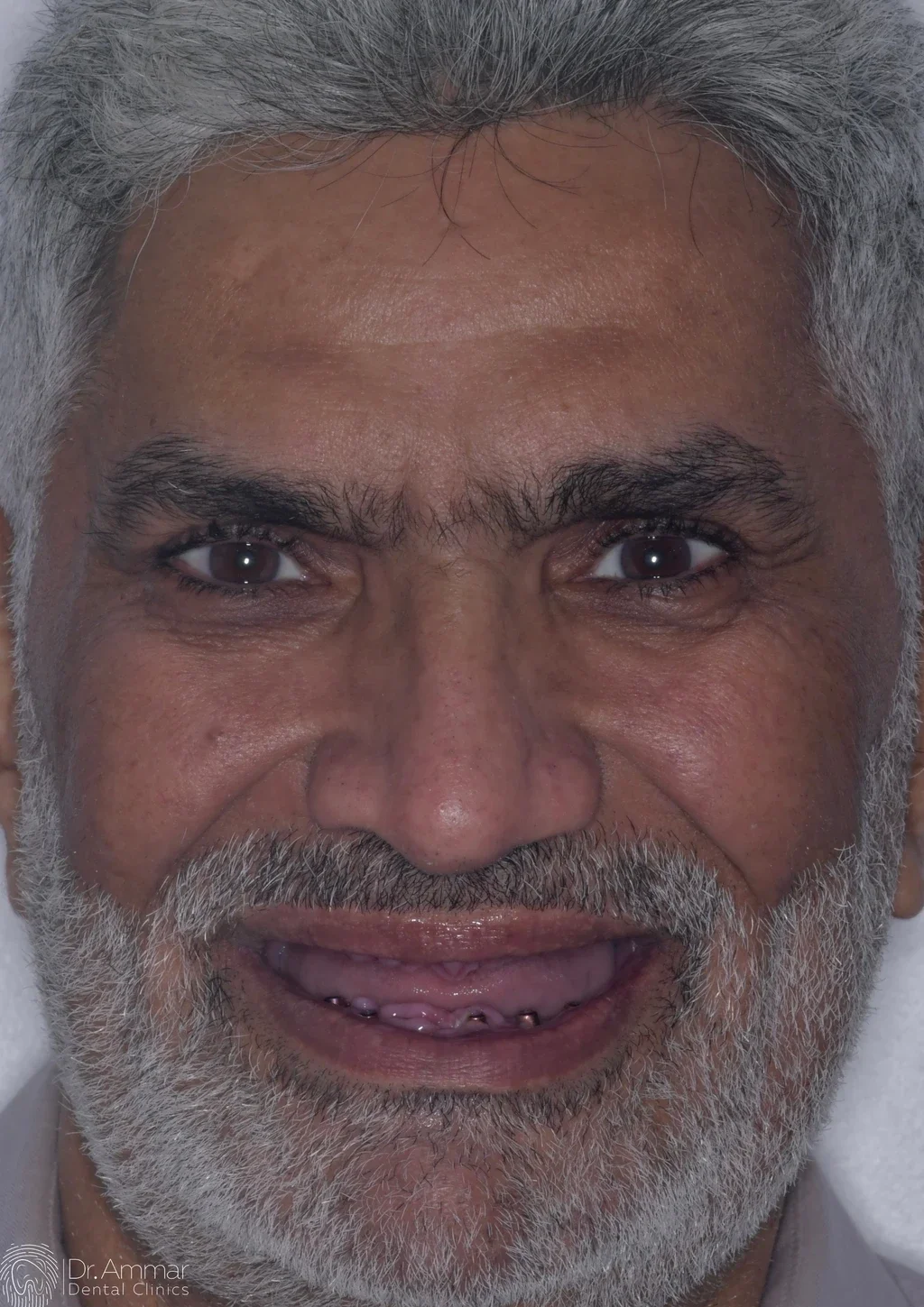 زراعة الفك بالكامل — قبل