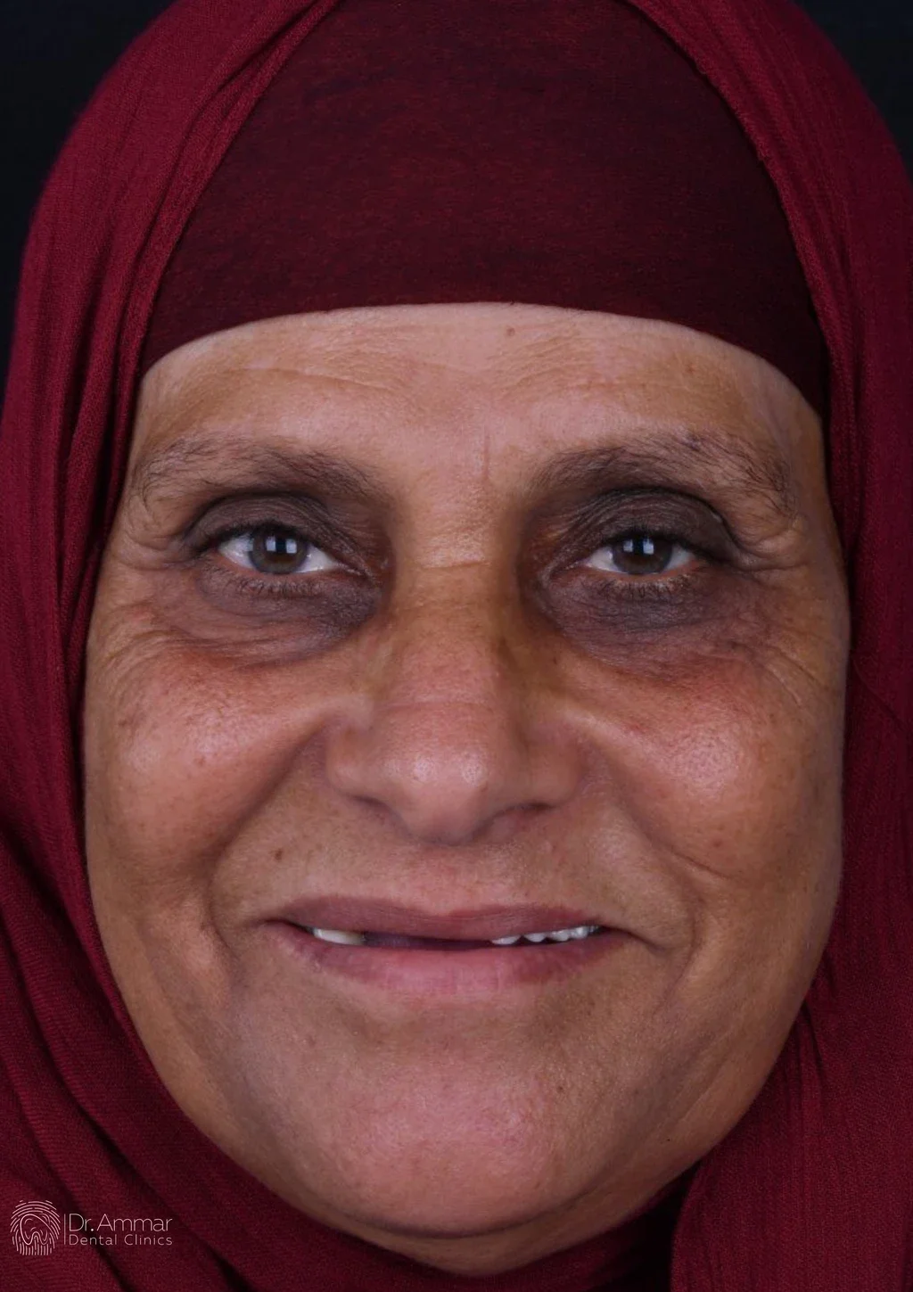زراعة الفك بالكامل — قبل