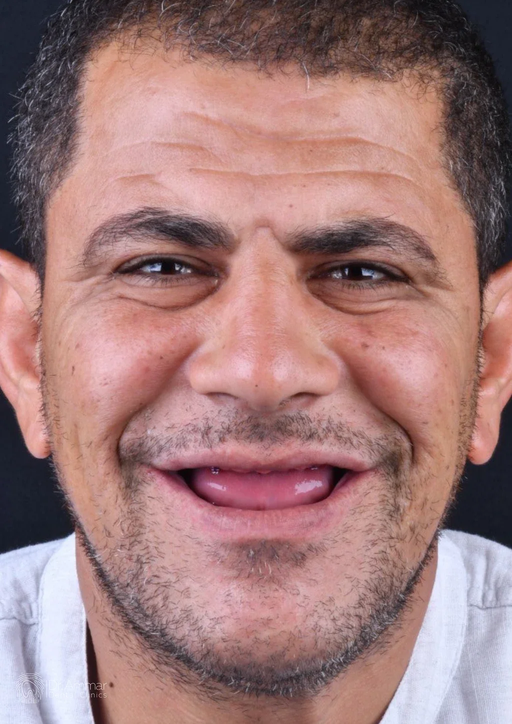 زراعة الفك بالكامل — قبل