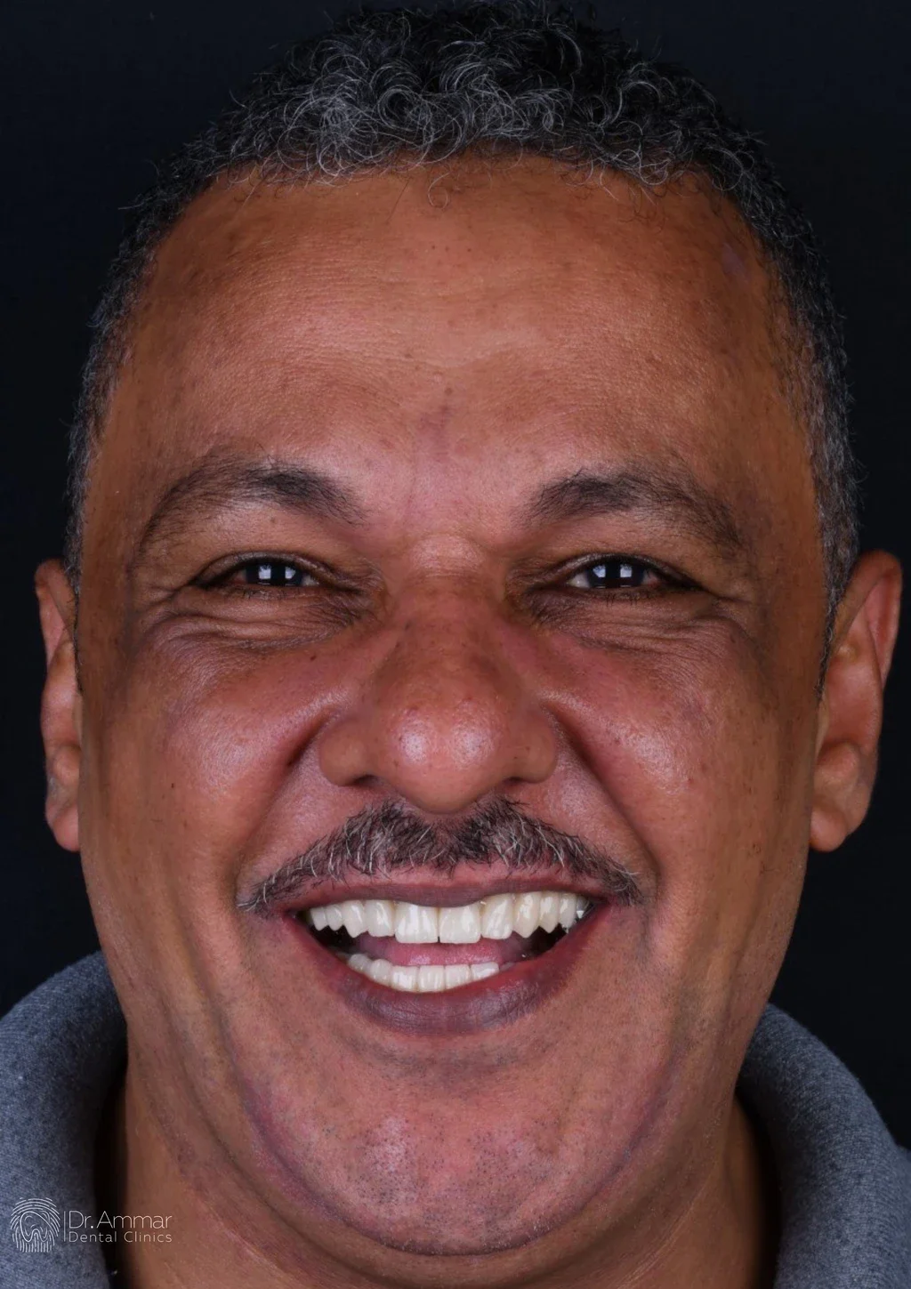 زراعة الفك بالكامل — بعد