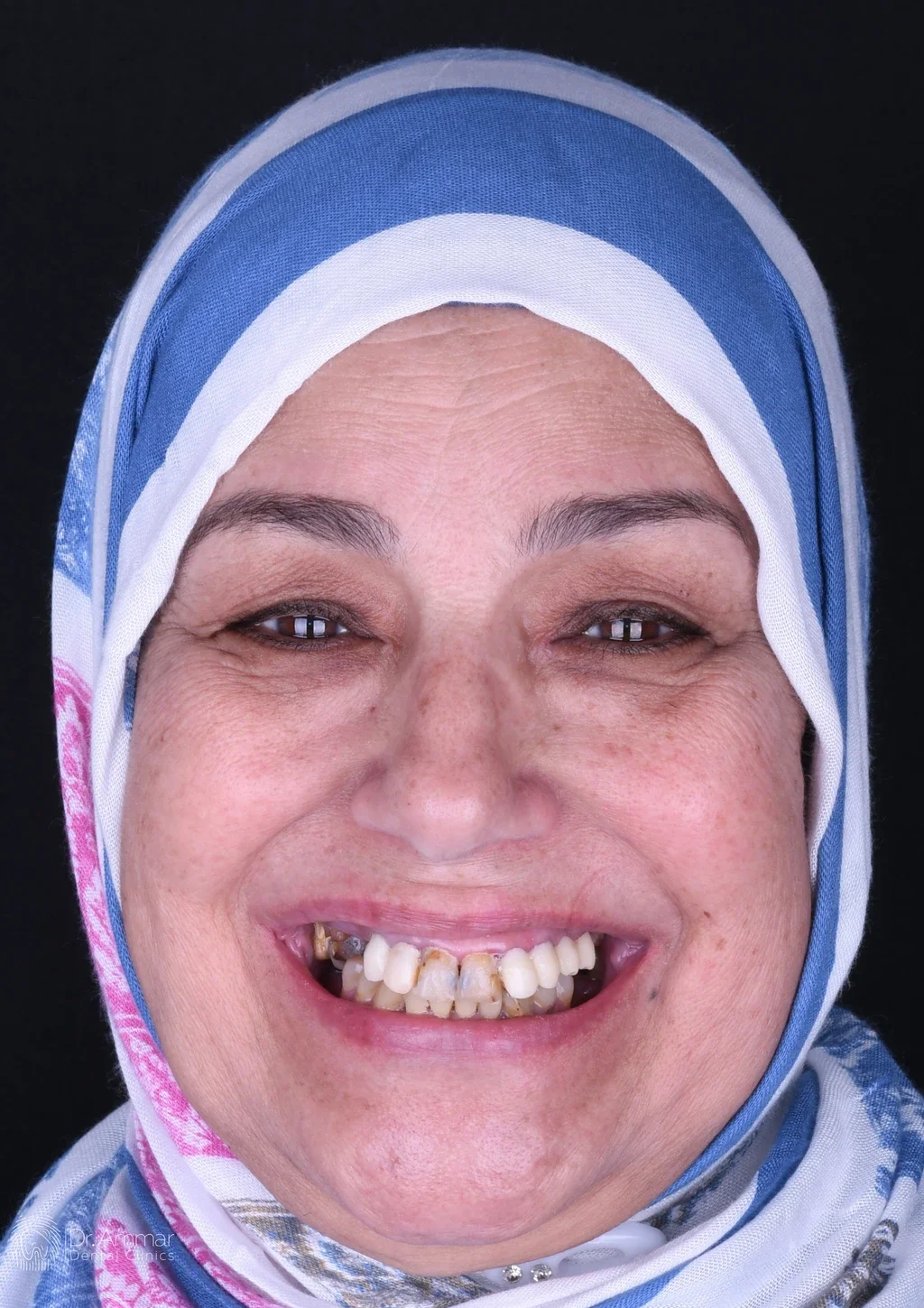 زراعة الفك بالكامل — قبل