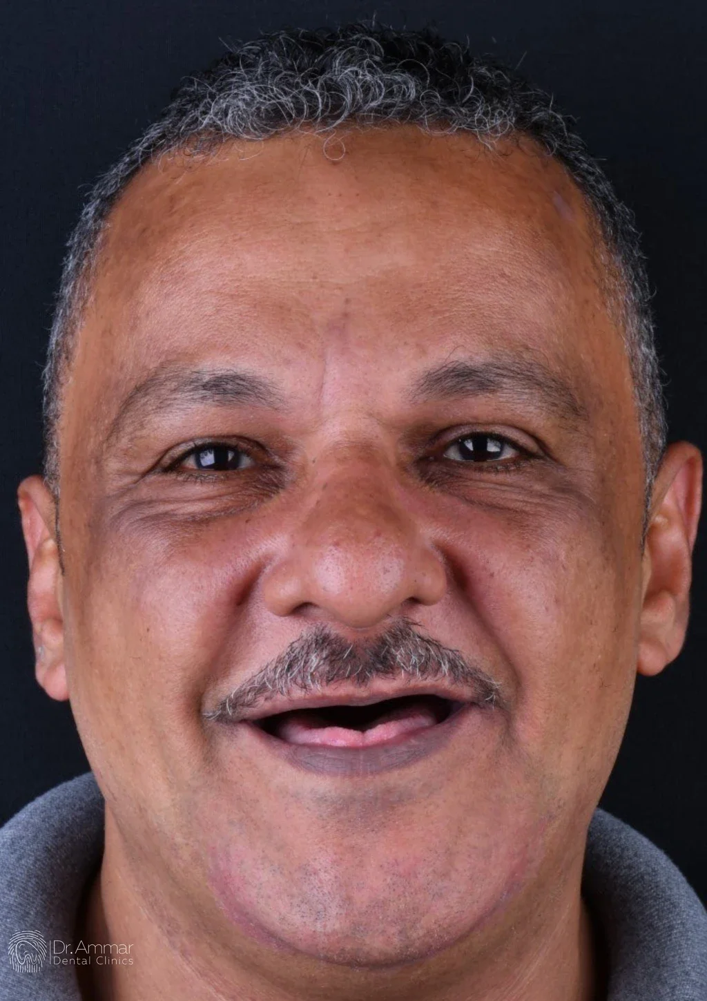 زراعة الفك بالكامل — قبل