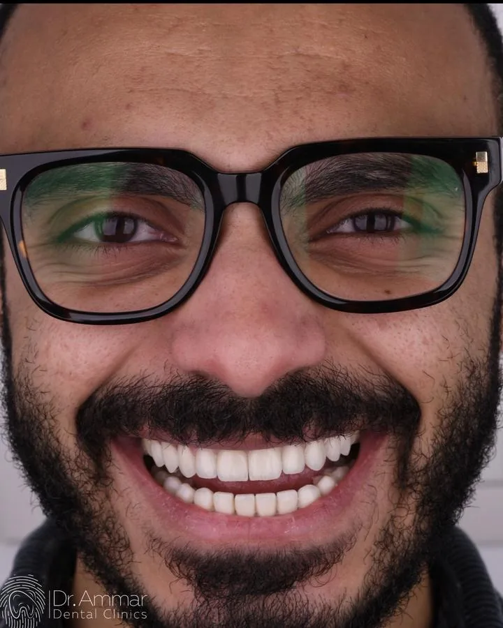 ابتسامة هوليوود — بعد