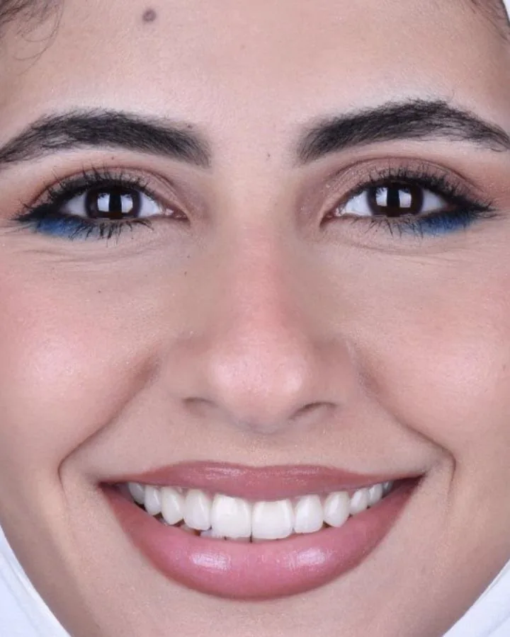 ابتسامة هوليوود — بعد