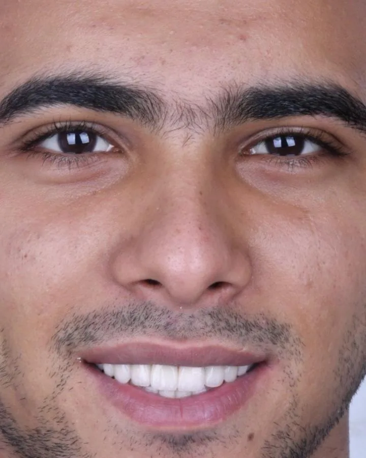 إعادة تأهيل الفكين — بعد