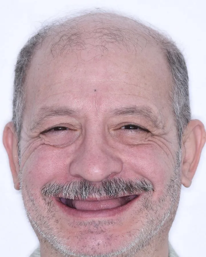 زراعة الأسنان — قبل