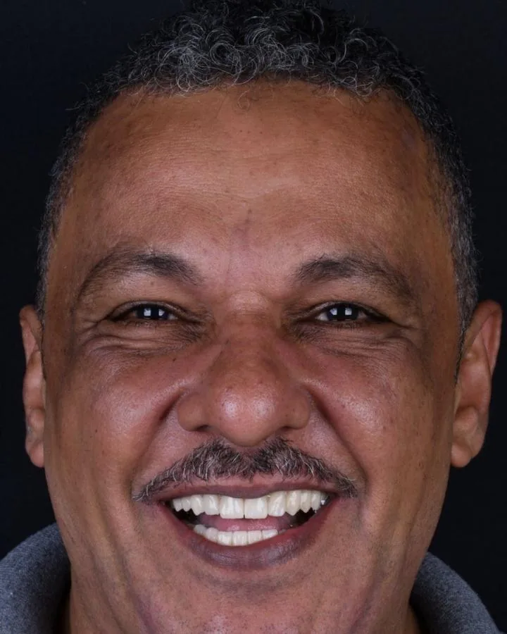 زراعة الأسنان — بعد