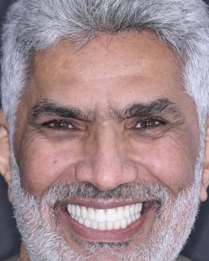 زراعة الأسنان — بعد
