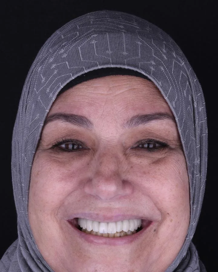 زراعة الأسنان — بعد
