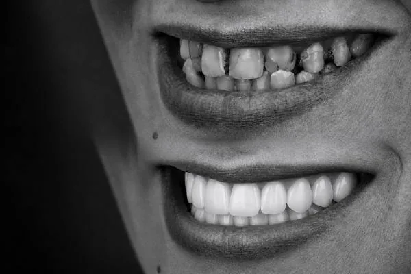 إعادة تأهيل الفكين